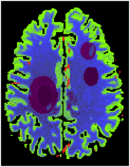 Towards entry "Digital Brain Perfusion Phantom"