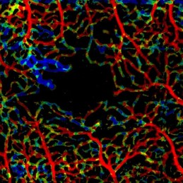 VISTA showing neovascularization having slow flow in PDR case