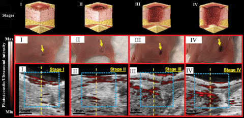 Towards entry "Jokerst Bioimaging Lab (UCSD) and PRL join forces to detect wounds"