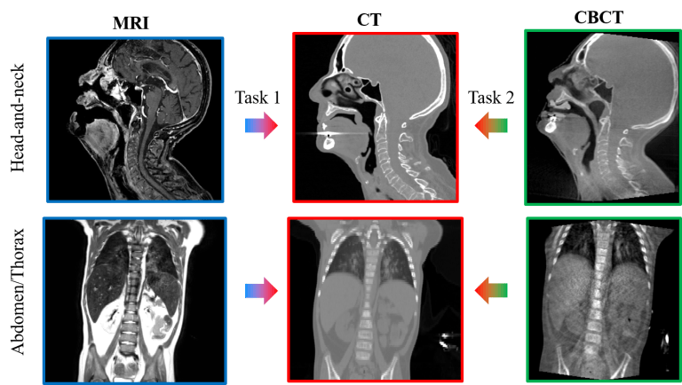 Pattern Recognition Lab Members win First Place in SynthRAD2025 Challenge